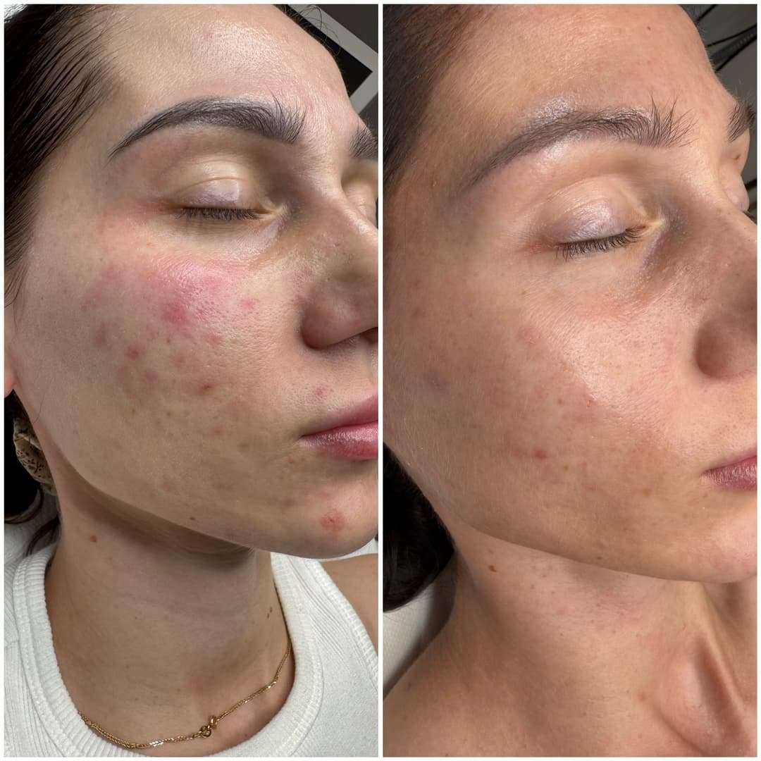 SQT® Bio-Microneedling – naturalna biostymulacja i intensywna odnowa skóry