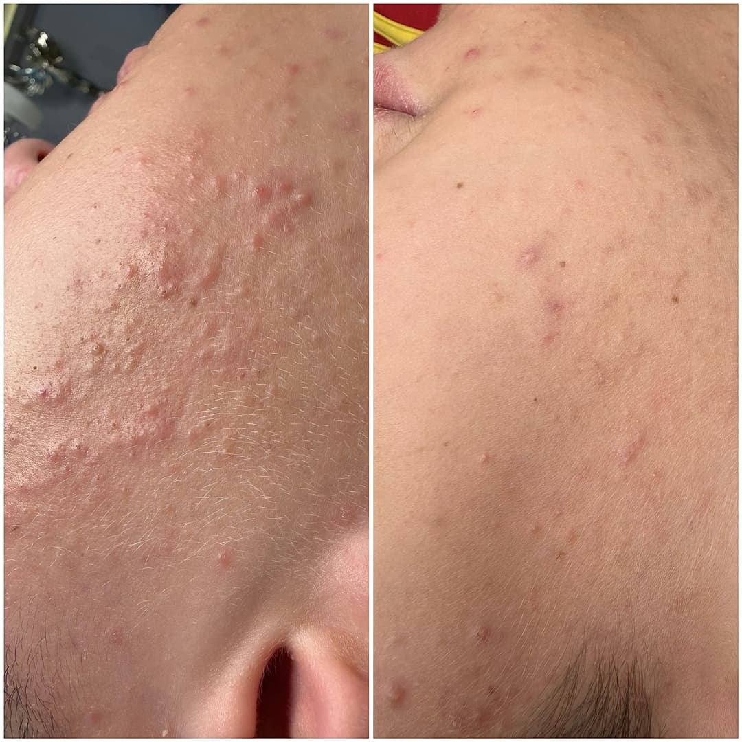 SQT® Bio-Microneedling – naturalna biostymulacja i intensywna odnowa skóry